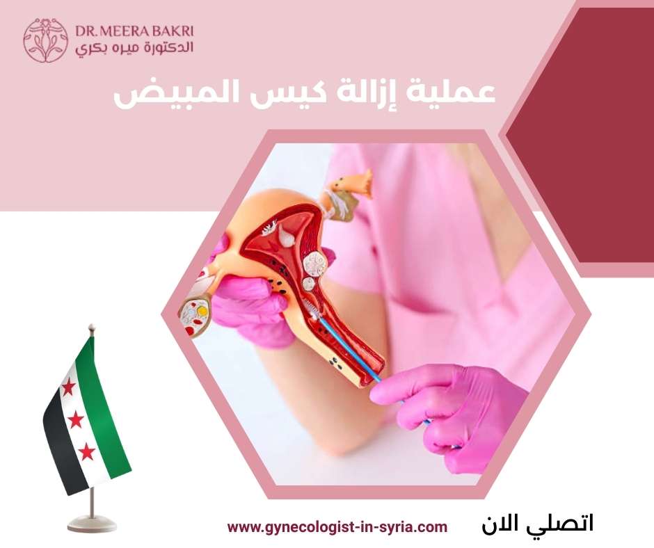 عملية إزالة كيس المبيض