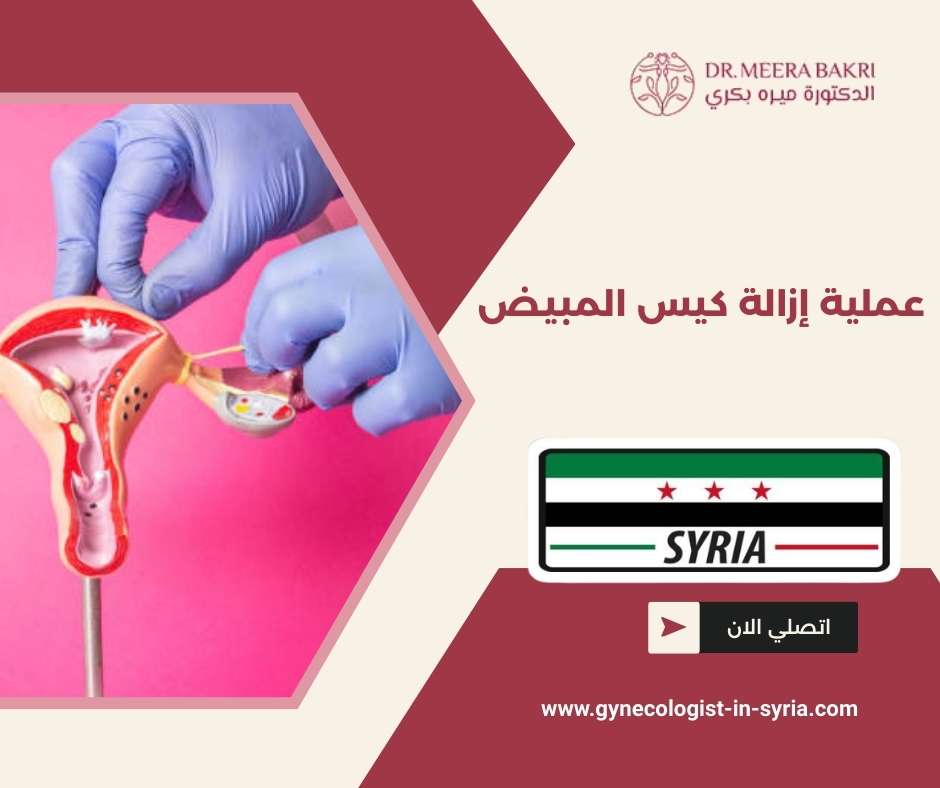 عملية إزالة كيس المبيض