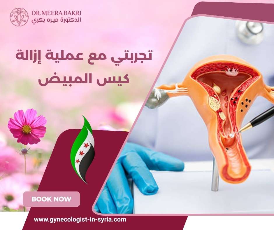 تجربتي مع عملية إزالة كيس المبيض