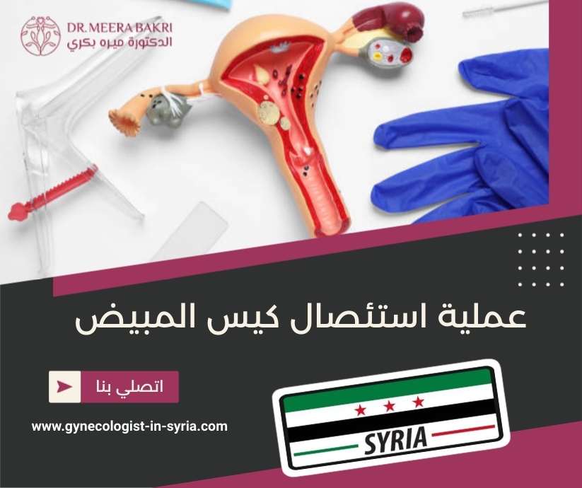 عملية استئصال كيس المبيض