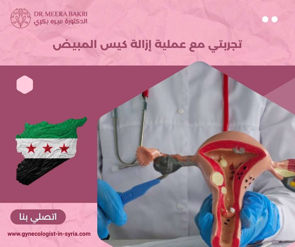 تجربتي مع عملية إزالة كيس المبيض
