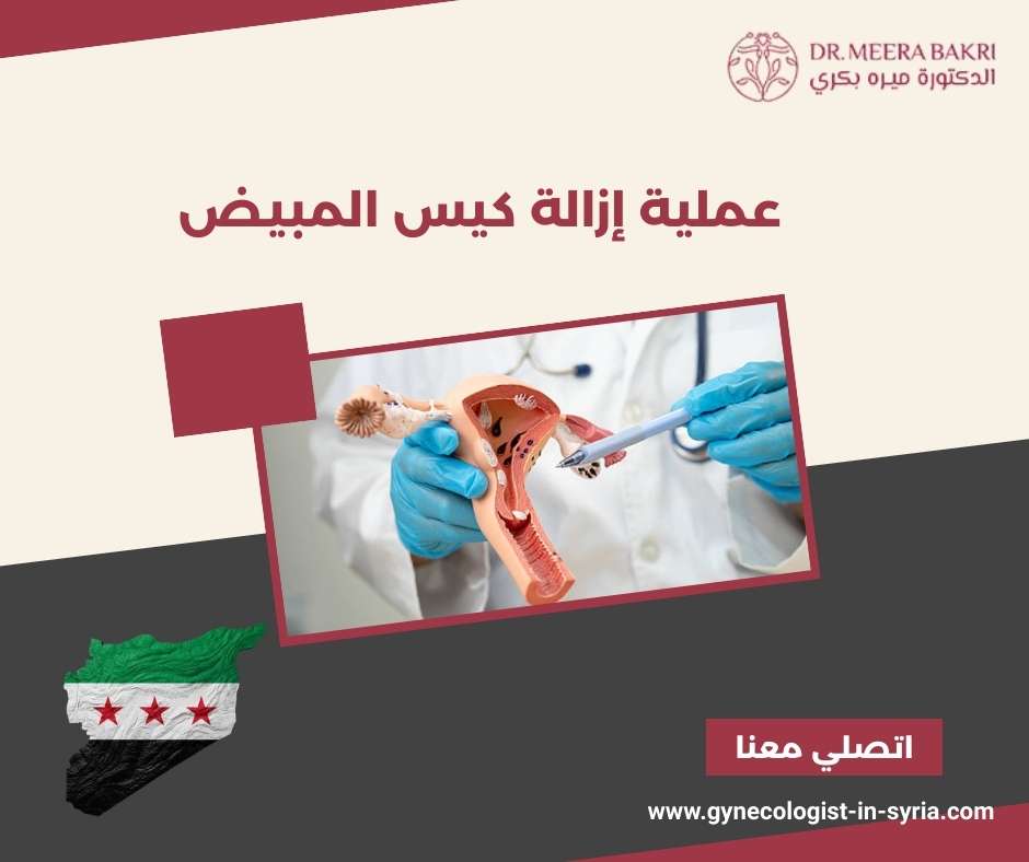 عملية إزالة كيس المبيض