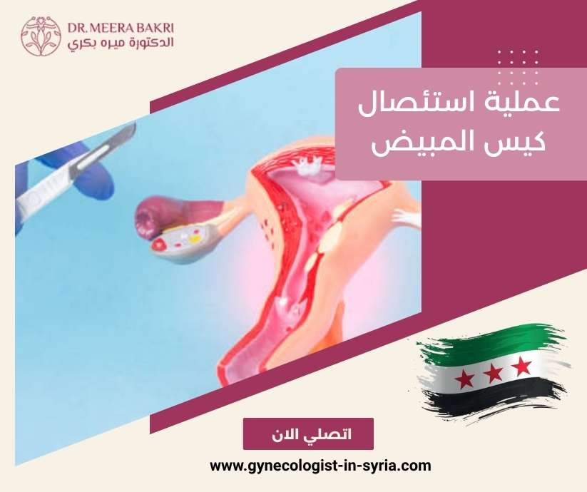 عملية استئصال كيس المبيض
