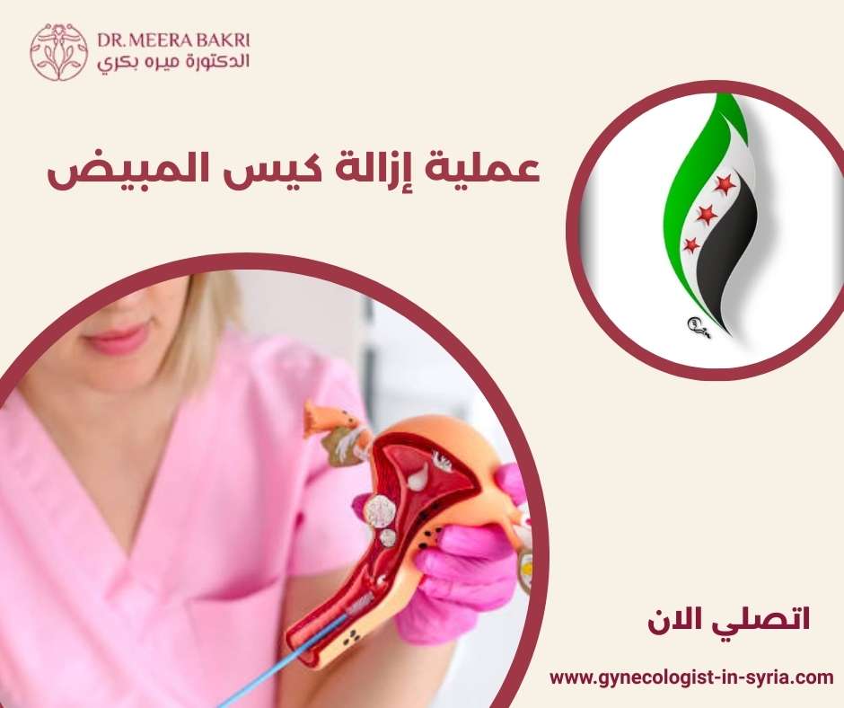 عملية إزالة كيس المبيض