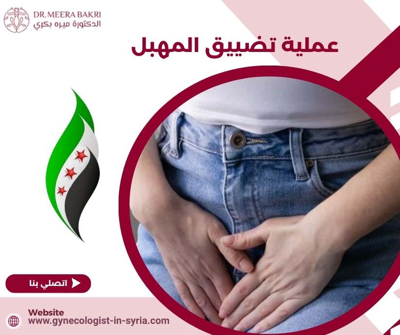 عملية تضييق المهبل