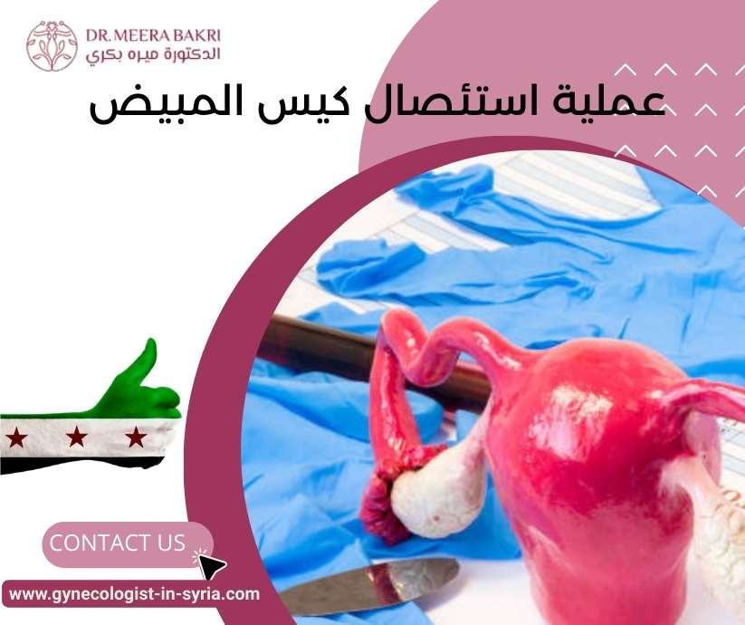 عملية استئصال كيس المبيض