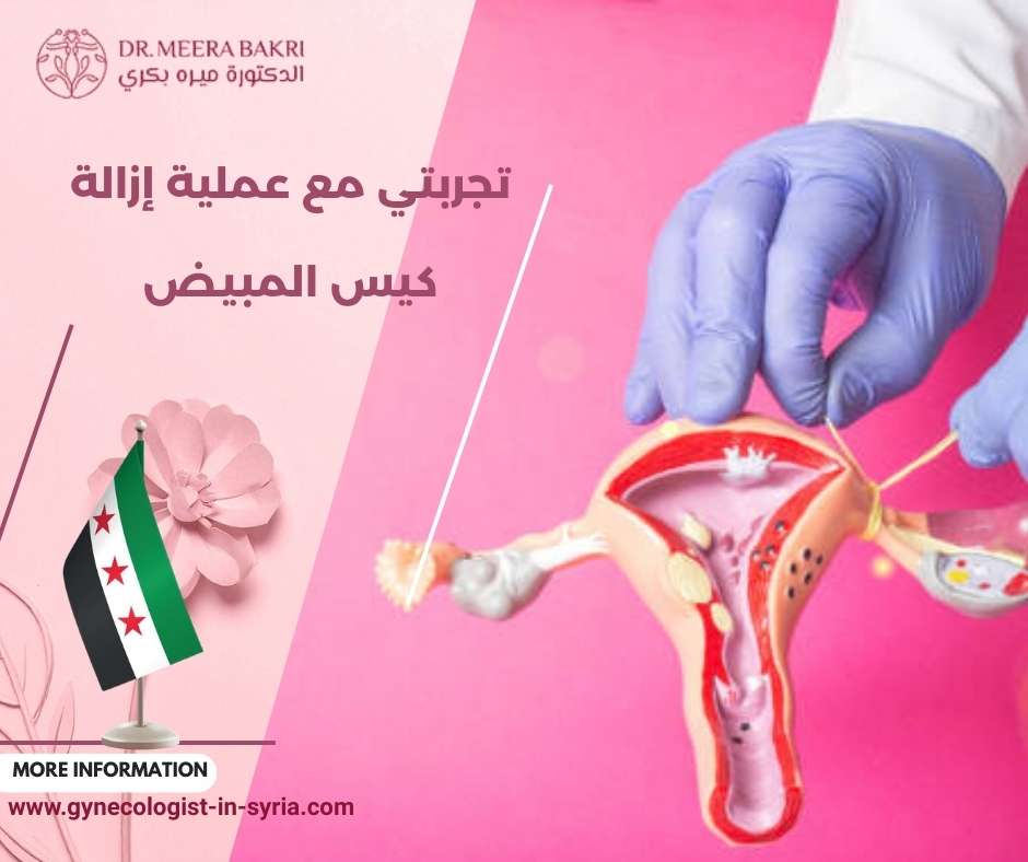تجربتي مع عملية إزالة كيس المبيض
